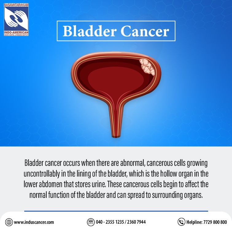 Bladder Cancer Understanding the Disease and Its Implications ...