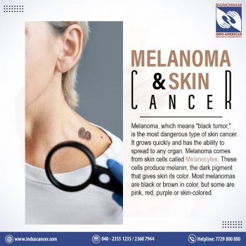 melanoma and skin cancer