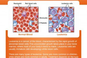 Comprehensive Guide to Leukemia Symptoms, Causes, Treatment, Types, Diagnosis, and Risk Factors
