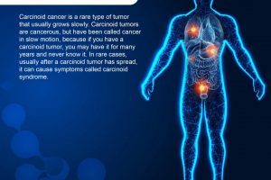 What is Carcinoid Cancer: