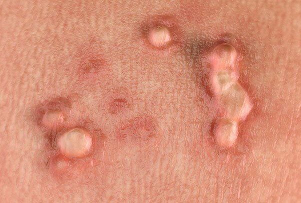 hpv-warts-722x406
