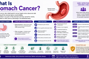 Stomach Cancer